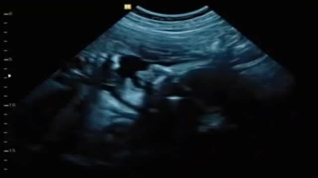 B超下的胎儿影像短视频素材